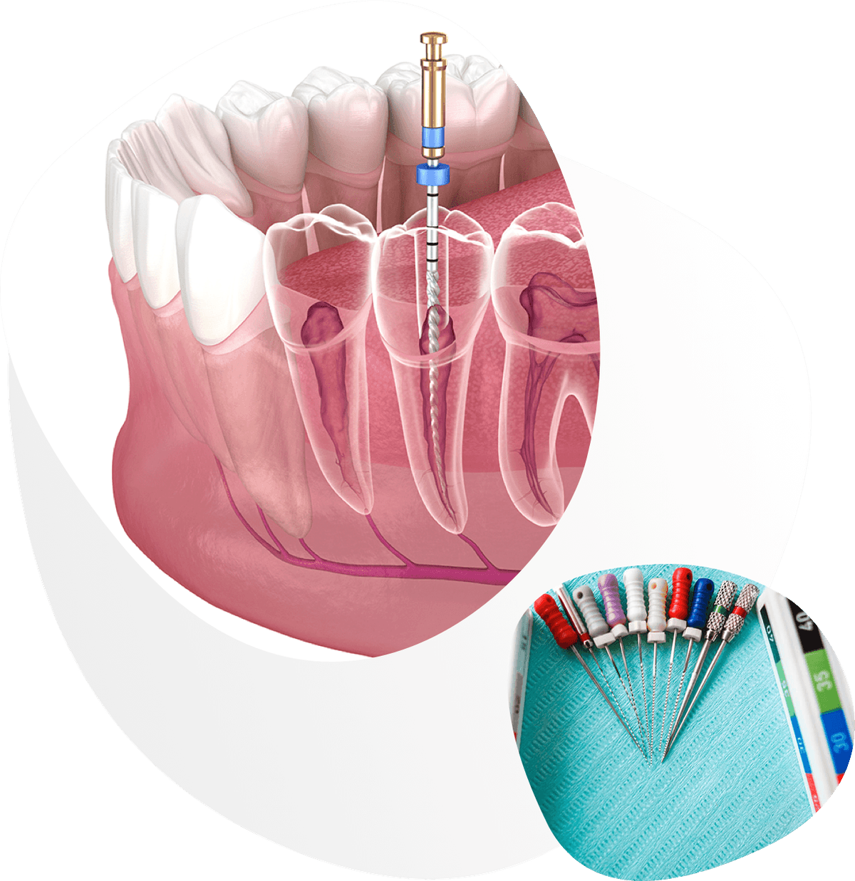 Endodoncija
(Liječenje zuba)