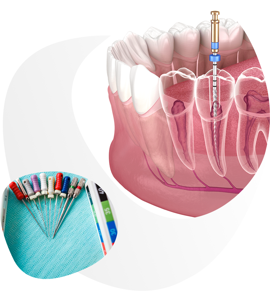 Endodoncija
(Liječenje zuba)