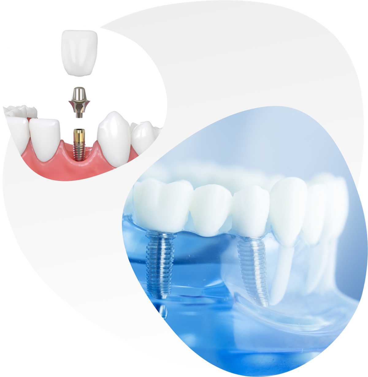 Zubni implantat
