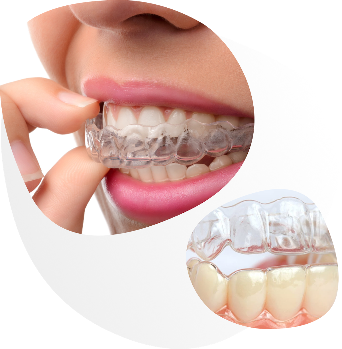 Prozirni aparatić za zube
